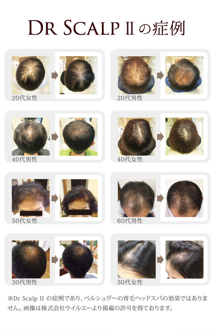 Dr ScalpⅡの症例